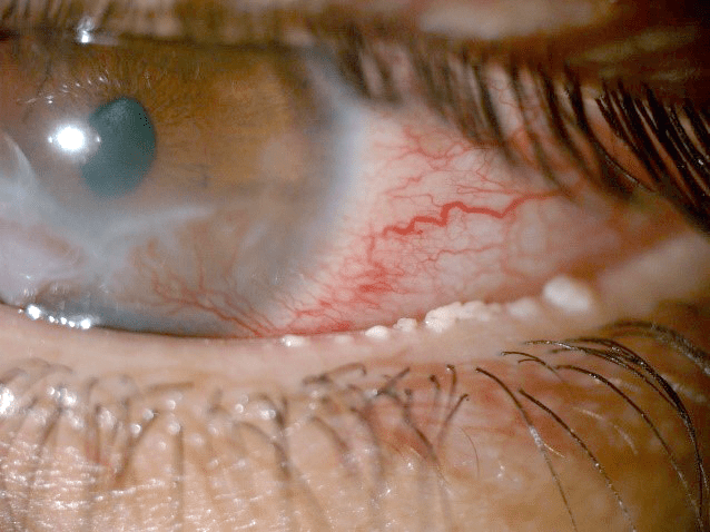 Como a blefarite afeta os olhos – Donato Hospital de Olhos