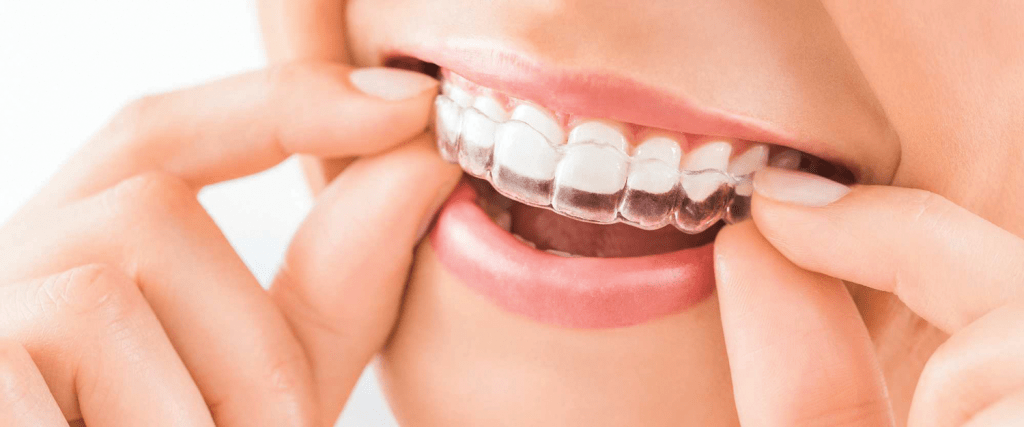 Alinhador invisível mitos e verdades! – Nunes Odontologia – Belo